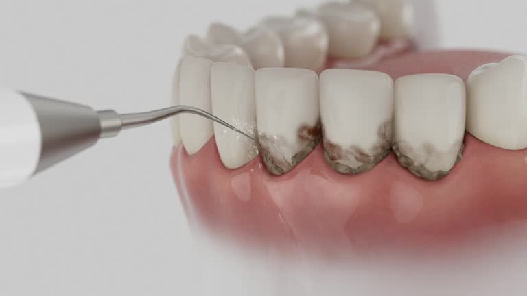 Trusted Wisdom Tooth Removal service in Bayview, CA - Dentist Open Now